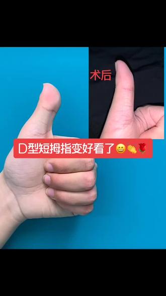 粗改┙谟侄逃粗-d型短指症
